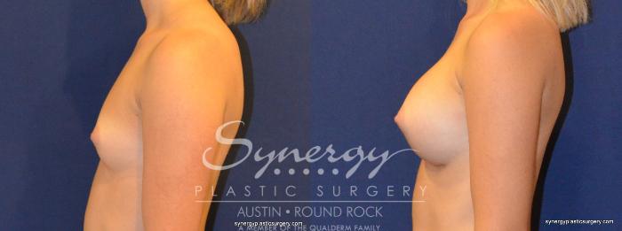 Before & After Breast Augmentation Case 327 View #4 View in Austin, TX