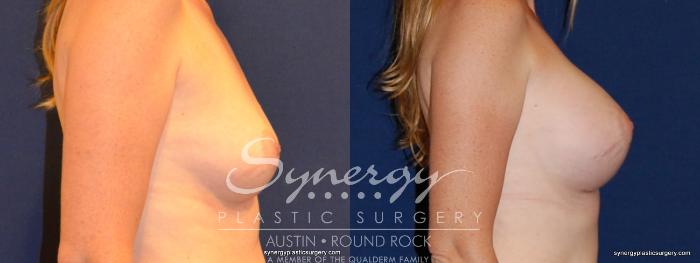 Before & After Breast Augmentation Case 330 View #2 View in Austin, TX