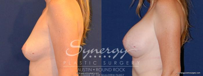 Before & After Breast Augmentation Case 330 View #4 View in Austin, TX