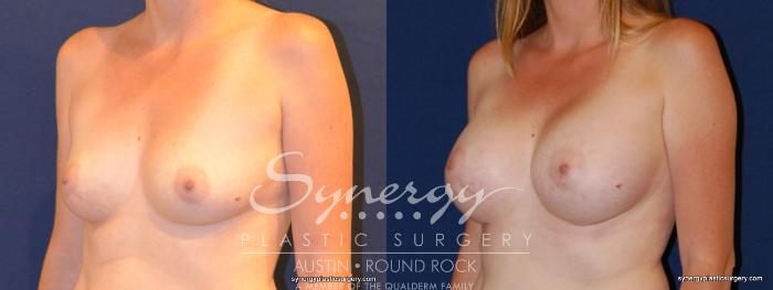 Before & After Breast Augmentation Case 330 View #5 View in Austin, TX