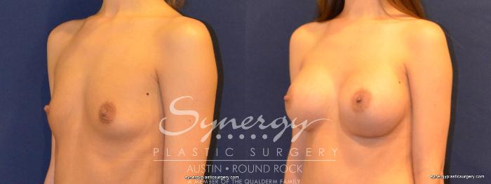 Before & After Breast Augmentation Case 336 View #2 View in Austin, TX