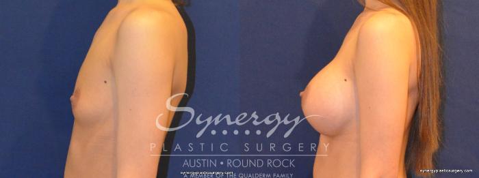 Before & After Breast Augmentation Case 336 View #3 View in Austin, TX