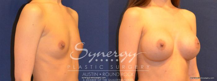 Before & After Breast Augmentation Case 336 View #4 View in Austin, TX