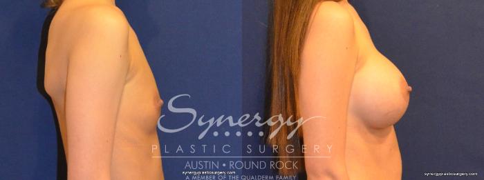 Before & After Breast Augmentation Case 336 View #5 View in Austin, TX