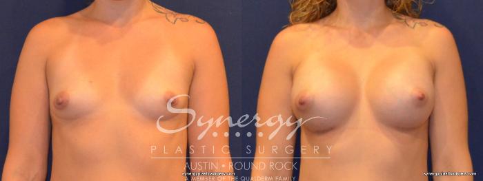 Before & After Breast Augmentation Case 341 View #1 View in Austin, TX