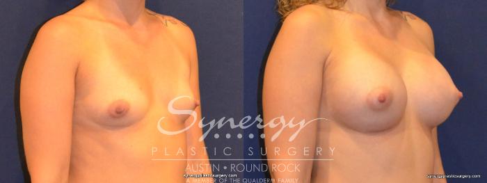 Before & After Breast Augmentation Case 341 View #2 View in Austin, TX
