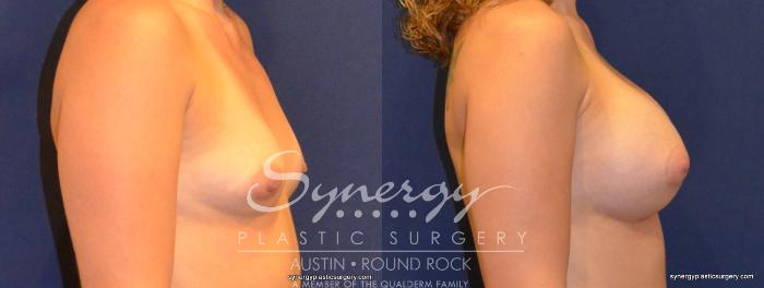 Before & After Breast Augmentation Case 341 View #3 View in Austin, TX