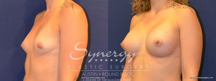 Before & After Breast Augmentation Case 341 View #4 View in Austin, TX