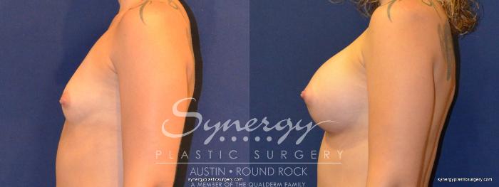 Before & After Breast Augmentation Case 341 View #5 View in Austin, TX