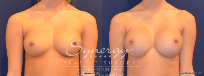 Before & After Breast Augmentation Case 343 View #1 View in Austin, TX
