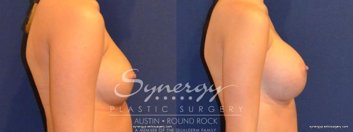 Before & After Breast Augmentation Case 343 View #2 View in Austin, TX