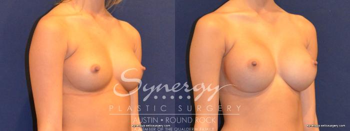 Before & After Breast Augmentation Case 343 View #3 View in Austin, TX