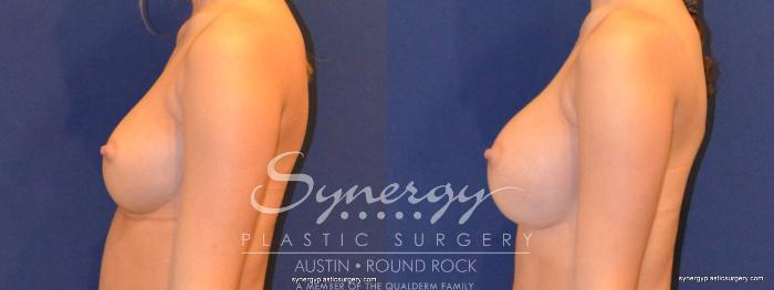 Before & After Breast Augmentation Case 343 View #4 View in Austin, TX
