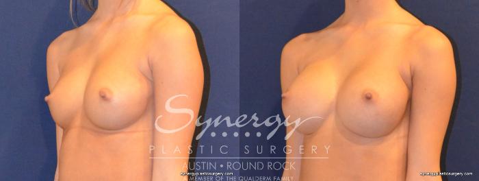 Before & After Breast Augmentation Case 343 View #5 View in Austin, TX