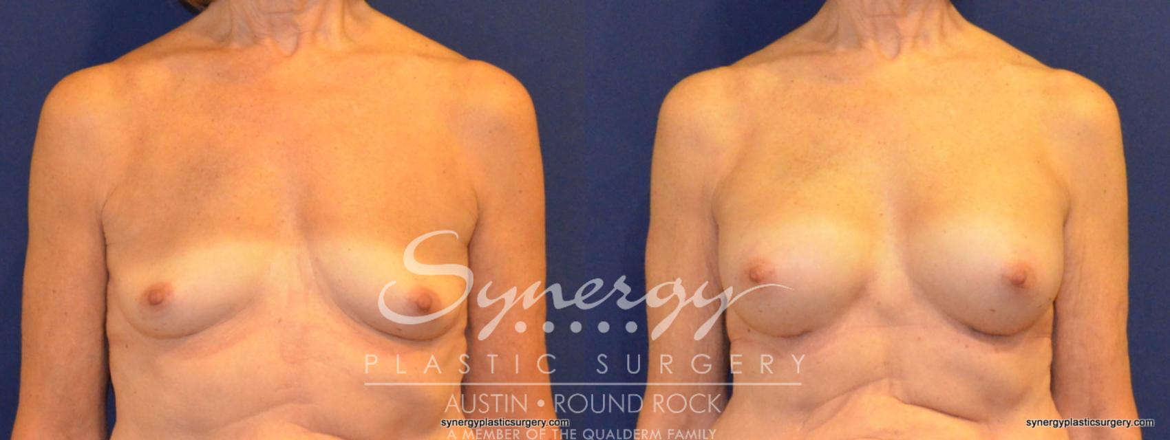 Before & After Breast Augmentation Case 346 View #1 View in Austin, TX