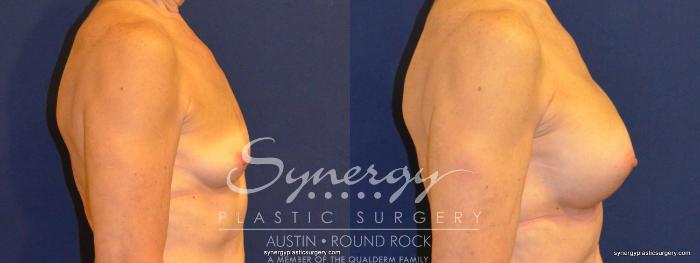 Before & After Breast Augmentation Case 346 View #3 View in Austin, TX