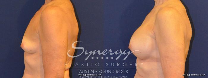 Before & After Breast Augmentation Case 346 View #4 View in Austin, TX