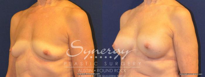 Before & After Breast Augmentation Case 346 View #5 View in Austin, TX