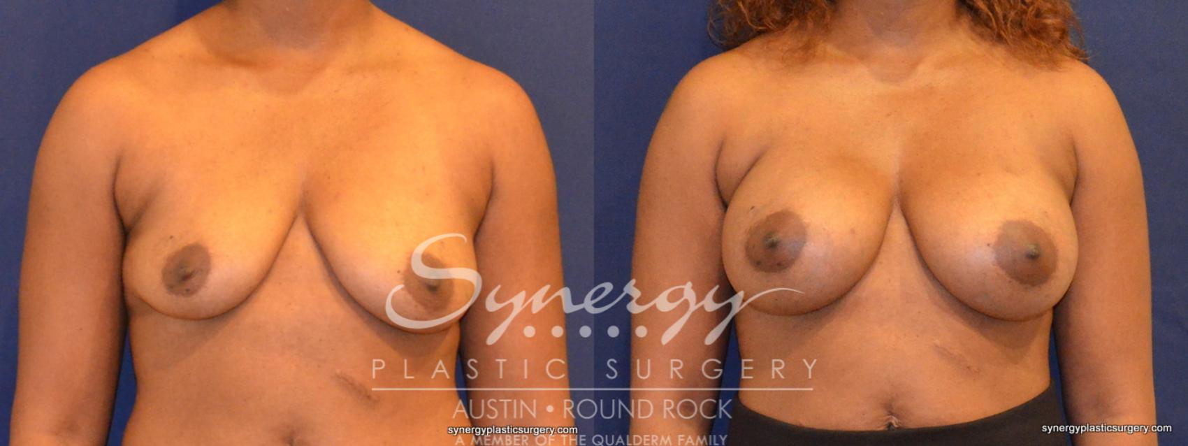 Before & After Breast Augmentation Case 347 View #1 View in Austin, TX