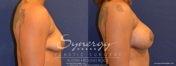 Before & After Breast Augmentation Case 347 View #2 View in Austin, TX