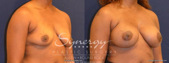 Before & After Breast Augmentation Case 347 View #3 View in Austin, TX