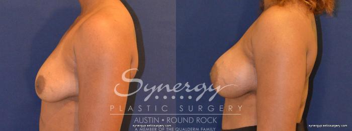 Before & After Breast Augmentation Case 347 View #4 View in Austin, TX