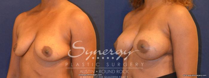 Before & After Breast Augmentation Case 347 View #5 View in Austin, TX