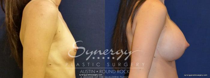 Before & After Breast Augmentation Case 350 View #2 View in Austin, TX