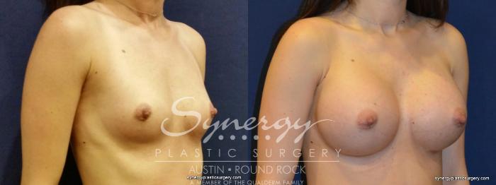 Before & After Breast Augmentation Case 350 View #3 View in Austin, TX