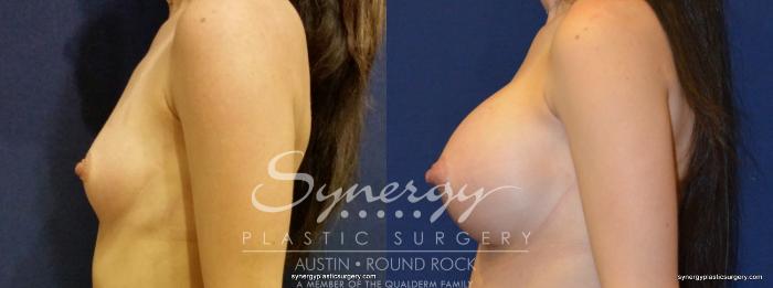Before & After Breast Augmentation Case 350 View #4 View in Austin, TX