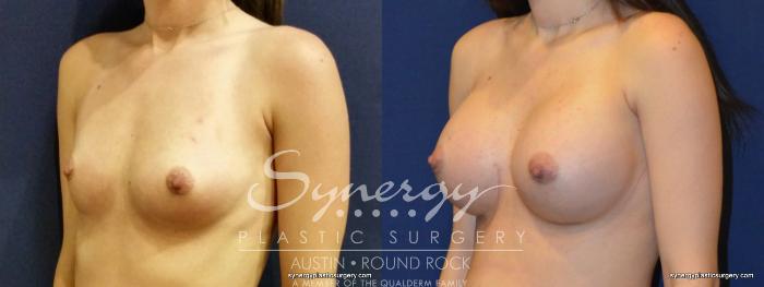 Before & After Breast Augmentation Case 350 View #5 View in Austin, TX