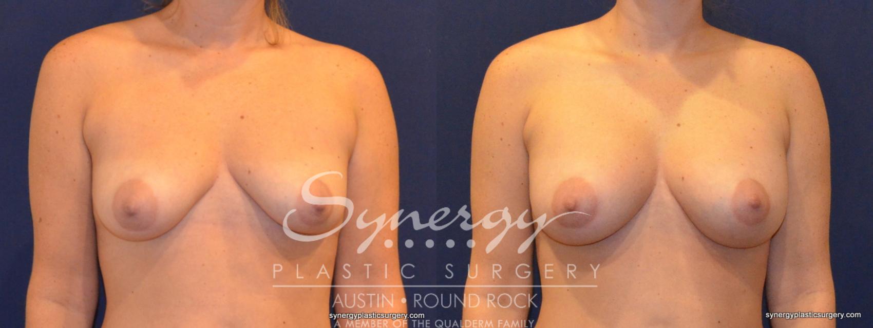 Before & After Breast Augmentation Case 351 View #1 View in Austin, TX