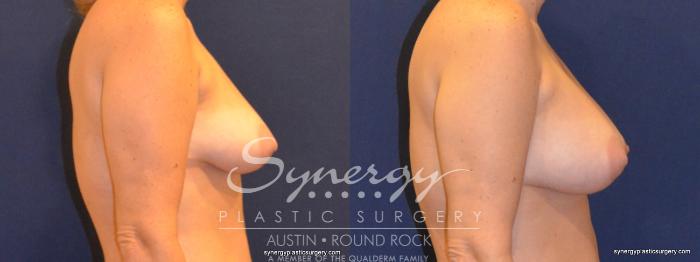 Before & After Breast Augmentation Case 351 View #2 View in Austin, TX