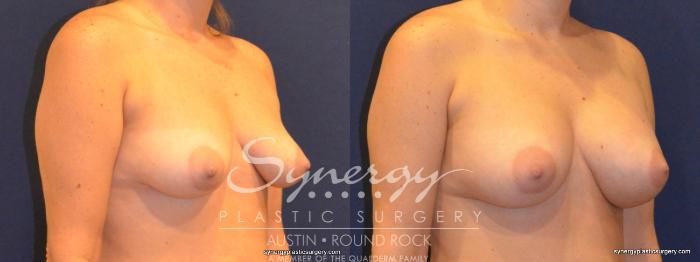 Before & After Breast Augmentation Case 351 View #3 View in Austin, TX