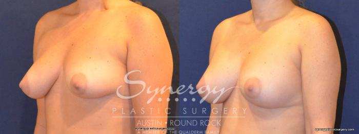 Before & After Breast Augmentation Case 351 View #4 View in Austin, TX