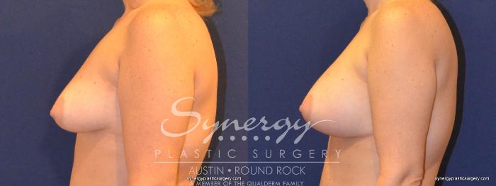 Before & After Breast Augmentation Case 351 View #5 View in Austin, TX