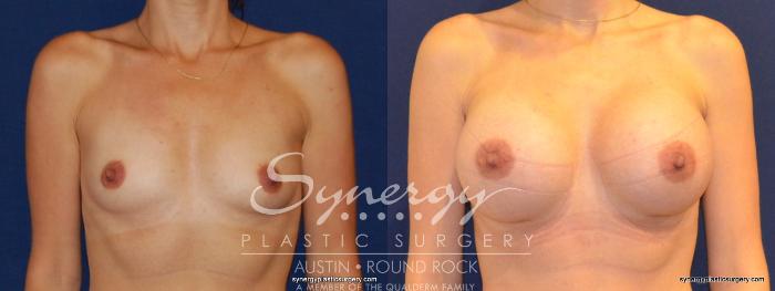 Before & After Breast Augmentation Case 352 View #1 View in Austin, TX