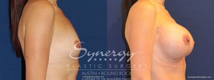 Before & After Breast Augmentation Case 352 View #2 View in Austin, TX