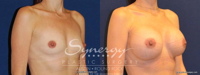 Before & After Breast Augmentation Case 352 View #3 View in Austin, TX