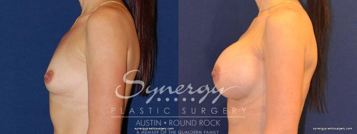 Before & After Breast Augmentation Case 352 View #4 View in Austin, TX