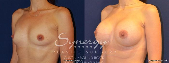 Before & After Breast Augmentation Case 352 View #5 View in Austin, TX