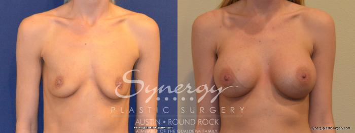 Before & After Breast Augmentation Case 355 View #1 View in Austin, TX