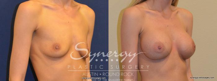 Before & After Breast Augmentation Case 355 View #2 View in Austin, TX