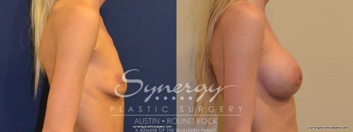 Before & After Breast Augmentation Case 355 View #3 View in Austin, TX