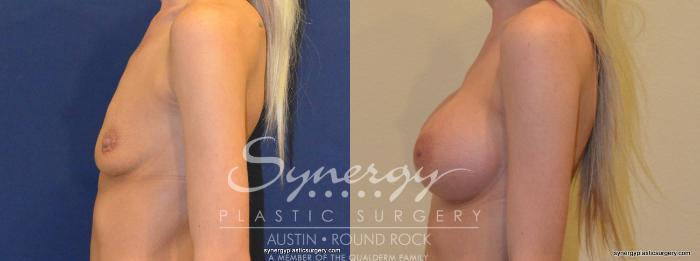 Before & After Breast Augmentation Case 355 View #4 View in Austin, TX