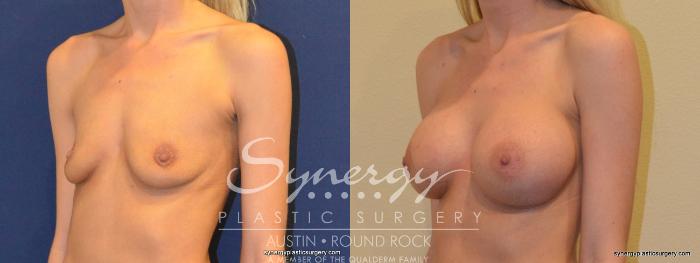 Before & After Breast Augmentation Case 355 View #5 View in Austin, TX
