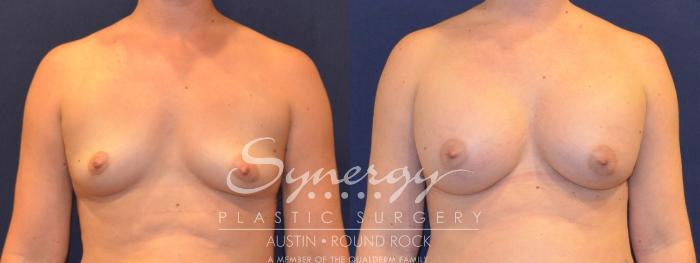 Before & After Breast Augmentation Case 357 View #1 View in Austin, TX