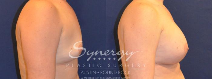 Before & After Breast Augmentation Case 357 View #2 View in Austin, TX