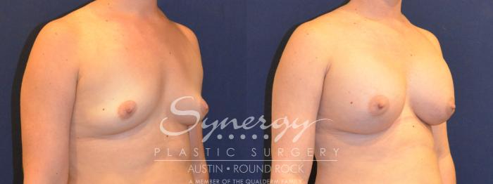 Before & After Breast Augmentation Case 357 View #3 View in Austin, TX