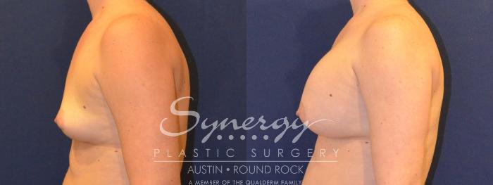 Before & After Breast Augmentation Case 357 View #4 View in Austin, TX